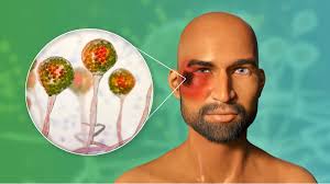 La variante delta puede confundirse con un resfriado fuerte. Otra Atroz Variante De Covid Puede Causar Gangrena Y Sordera El Financiero