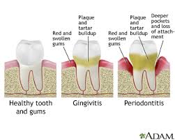 Dişin ağızda durmasını sağlayan, yumuşak dokuları ve esas desteği veren kemiği harap eden önemli bir diş eti hastalığıdır. Periodontitis Information Mount Sinai New York