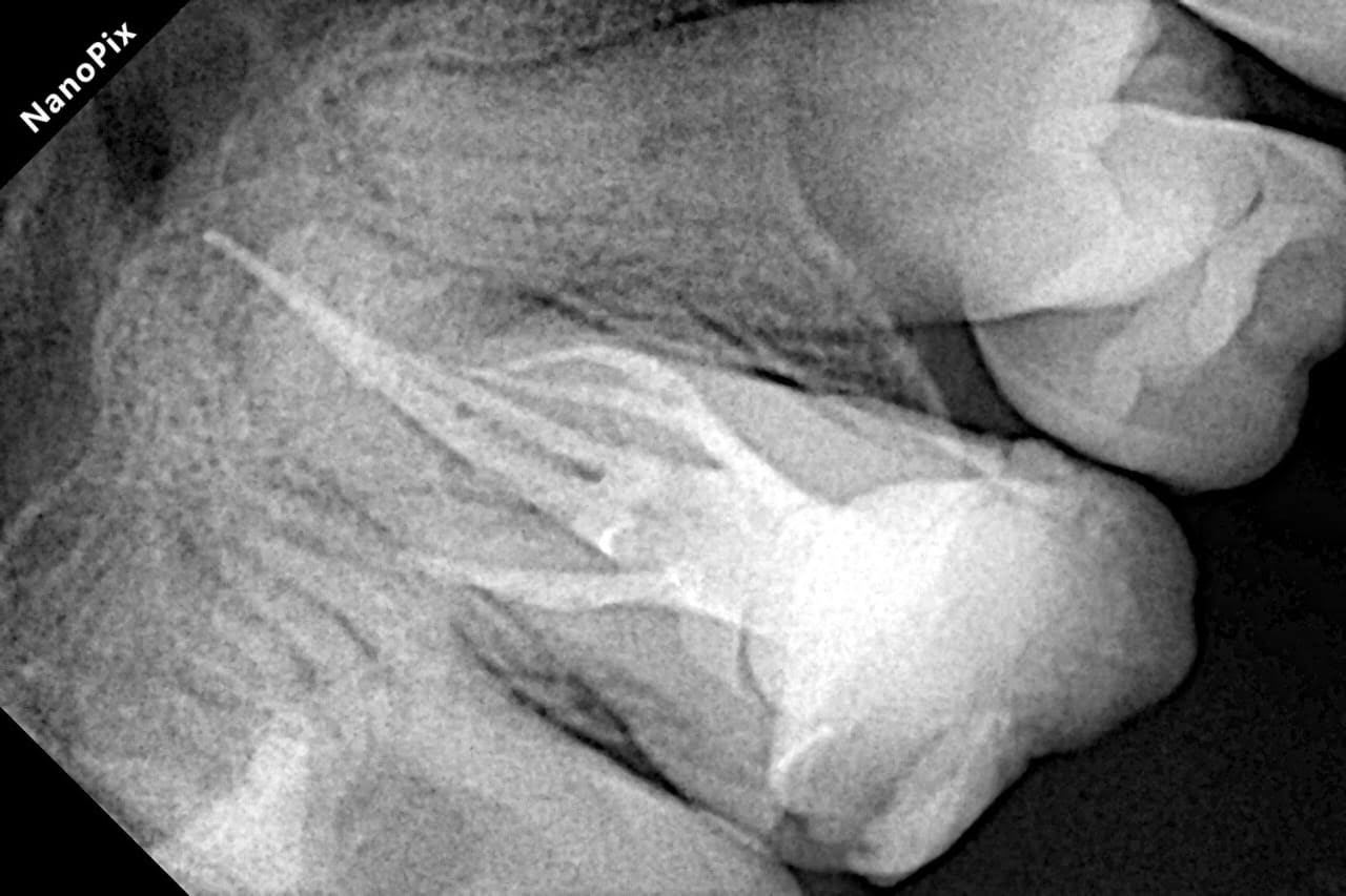 Root canal treatment (RCT) product image