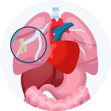 It assesses the disease according to a variety of factors. Stages Of Mesothelioma Mesothelioma
