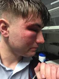Man speaks out after suffering head injuries in unprovoked attack in  Taunton