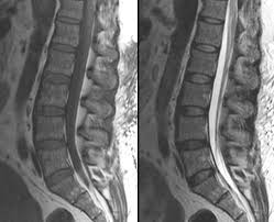 In a prospective multicenter study, two blinded raters independently examined cervical spine magnetic resonance (mr) images of 140 healthy . Normal Sagittal Mri