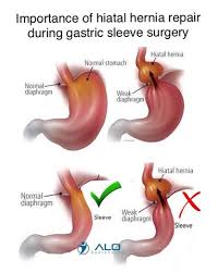 Hietal Hernia Repair During Bariatric Surgery By Alo Bariatrics Sleeve Surgery Hernia Repair Gastric Sleeve Surgery