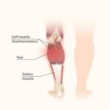 One way to help prevent this is to stretch your calves regularly, especially after exercises that work the calves (such as running). Sore Calves A Full Guide The Best Stretches And Exercises