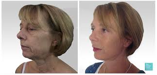 Facelift Surgery Clinic, London Facial Plastic Surgeon‎, Expert Facelift  Surgeon