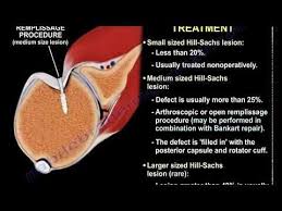 Lesions Of The Shoulder Hill Sachs Lesion Everything You Need To Know Dr Nabil Ebraheim Shoulder Dislocation Shoulder Surgery Physical Therapy School