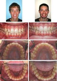 Maybe you would like to learn more about one of these? Invisalign Braces In Ebensburg Pa Joseph Cavalier Dmd