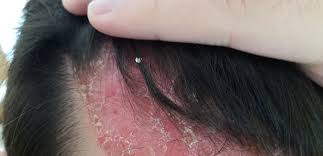 Seboreik dermatit rekürren(tekrarlayan), birçok eşlik eden faktörle birlikte görünen (maya, mantar, bakteri, virüs.) ve bulaşıcı bir hastalıktır. Seboreik Dermatit Dr Hilal Gokalp