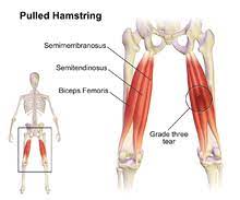 Refers to person, place, thing. Pulled Hamstring Wikipedia