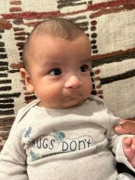 What are the best treatment options for craniosynostosis in a 4-month-old  baby?