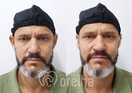 Correção Orelhas de Abano sem Otoplastia