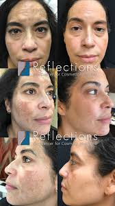 Image result for Melasma