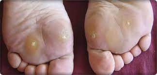 Methods Of Treating Fish Eye Warts Causes And Types Vision Egypt News