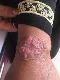 Image result for Deep Folliculitis