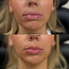 Now that's just my style 💉 Want a little plump before your next vacation?  Link in bio 🏖️🌴☀️