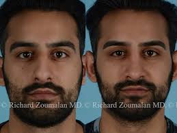 It is also traditional for men to sport long hair and beards. Middle Eastern Rhinoplasty Beverly Hills Nose Surgery Dr Zoumalan