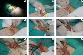 Infants generally bounce back from male circumcision faster than adults. Nerve Sparing Circumcision Myth Or Reality Sciencedirect