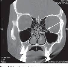 Image result for Maxillary Sinus