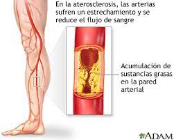 Arteriopatia Periferica En Las Piernas Medlineplus Enciclopedia Medica