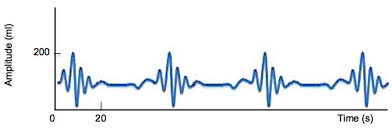 Image result for Cheyne-Stokes Respiration