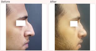 Jul 11, 2017 · in terms of age, any patient under the age of 18 will require a parent present to sign the consent. Rhinoplasty Surgery In Delhi Nose Reshaping Cost Dr Rajat Gupta