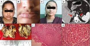 Clinical description although the majority of cases are diagnosed in the 2nd and 3rd decades. Primary Pigmented Nodular Adrenocortical Disease Ppnad Single Centre Experience
