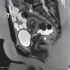 peritoneal mesothelioma is a type of cancer found in the peritoneum, a thin membrane surrounding the abdomen. Benign Multicystic Peritoneal Mesothelioma Airp Best Cases In Radiologic Pathologic Correlation Radiographics