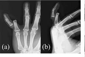 Image result for Lateral PIP Dislocation