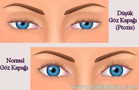 goz kapagi dusuklugu nedenleri ve tedavisi tatli portal