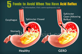 5 Foods To Avoid When You Have Acid Reflux