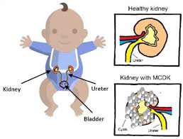 Fetal Multicystic Dysplastic Kidney Mcdk What You Need To Know