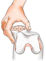 Image result for Patella Tracking Assessment
