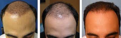 At this point, further density is unlikely to noticeably improve without further surgical and/or nonsurgical intervention (prp). Hair Transplant With Delayed Growth Parsa Mohebi Hair Restoration Parsa Mohebi Hair Restoration