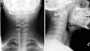 The most common symptom of thyroid cancer is a hard lump on the neck—but most patients experience no symptoms at all. Radiologic Evaluation Of Larynx Springerlink