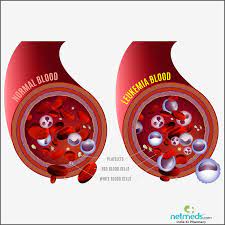 Instead of having a tumor in one organ growing larger and larger, and then spreading to other tissues, in leukemia cancer starts in the stem cells that will ultimately become blood cells. Blood Cancer Leukemia Causes Symptoms And Treatment Netmeds