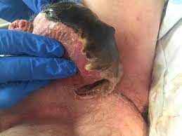 The topic fournier disease you are seeking is a synonym, or alternative name, or is closely related to the medical condition fournier gangrene. Fournier Gangrene A Rare Flesh Eating Disease Page 2 Of 4 Clinical Advisor