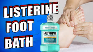 When mild, it looks like white and these ingredients soothe the skin while addressing foot and toenail fungus. Listerine Vinegar Foot Miracle Soak Recipe For Toenail Fungus Dead Skin Calluses Cracked Heels Youtube