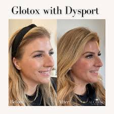 First time Dysport treatment for this gorgeous lady! Areas treated:   Forehead 11's Brow Lift  Crows feet Lip flip DAO (frown muscle) Five  Things NOT to do after Glotox: 1. Never sit in