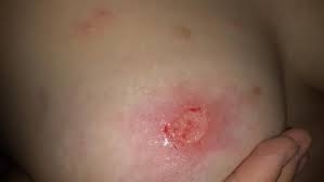 Heftige Entzundung Wegen Muckenstich Was Tun Brust Mueckenstich Schmerzhaft