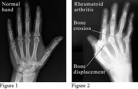 Image result for XRay Changes in Rheumatic Conditions