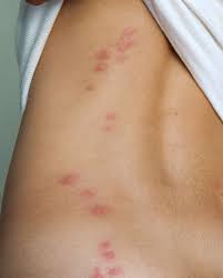 Itchy bumps on skin like mosquito bites. 11 Common Bug Bite Pictures How To Id Insect Bites And Stings