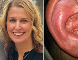 Shingles can hit hard and do lasting damage