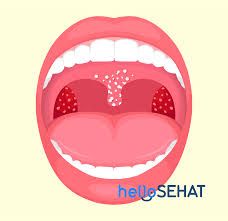 I also have great oral. Meski Tampak Sama Ini Beda Oral Thrush Lidah Peta Dan Ohl