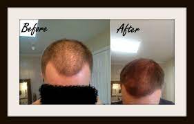 This kind of loss of hair is called androgenetic alopecia, typically described as male pattern baldness. Our Hair Loss Diet Completely Reverses Hair Thinning Balding