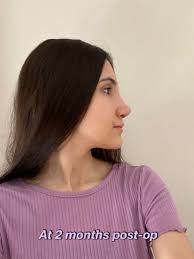 What do you guys think of her new profile?! 💜 REVISION RHINOPLASTY BEFORE  & 1 YEAR POST OP 👃👍 Trusted with Noses Worldwide®  ———————————————————————— 📱 📱 Text us at: 1 (424) 383-6509