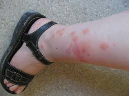 Maybe you would like to learn more about one of these? Chca Nas Pozrec Zywcem Czy Da Sie Uciec Przed Chmara Komarow