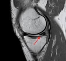 Der meniskus ist eine halbmondförmige knorpelscheibe im knie, von denen der mensch in jedem bei sportverletzungen ist meist der innenmeniskus betroffen, da dieser durch die physiologische. Meniskus Kniechirurg Eu