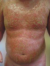 Publicado por grupo ap às 16:05. Https Www Researchgate Net Publication 245832832 Psoriase Na Infancia E Na Adolescencia Fulltext 57a8e05208aed1b22624497a Psoriase Na Infancia E Na Adolescencia Pdf