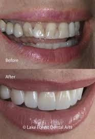 Before sharing sensitive information, make sure you're on a federal government site. Cosmetic Dentistry Before And After Photos Treatment Examples