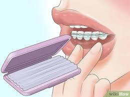 Maybe you would like to learn more about one of these? 4 Ways To Deal With A Palate Expander Wikihow